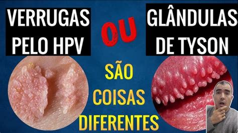 glandulas de tyson ou hpv|Glândulas de Tyson: o que são e veja se é preciso tratá